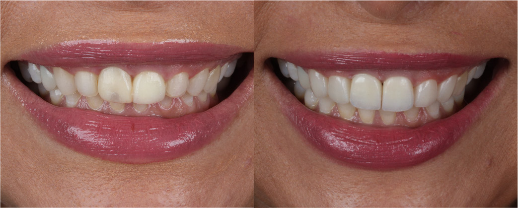 sorriso-antes-depois-01