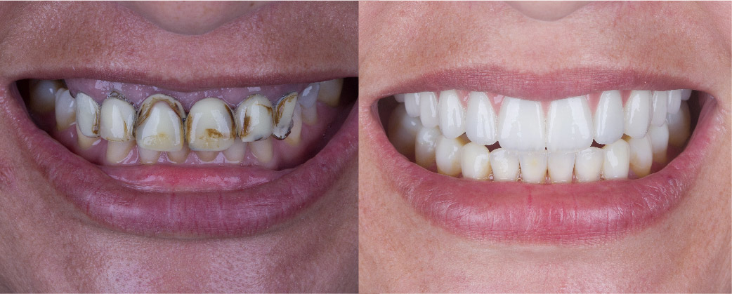 sorriso-antes-depois-03