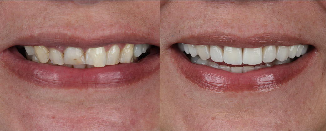 sorriso-antes-depois-04