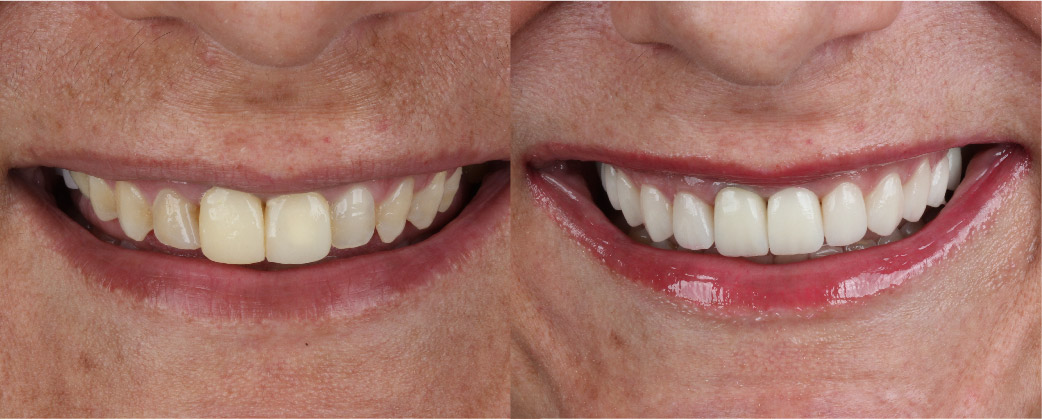 sorriso-antes-depois-05